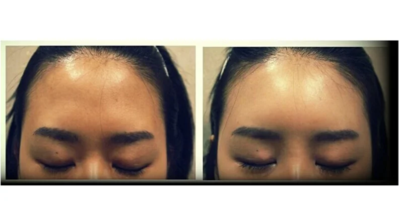 Forehead Filler