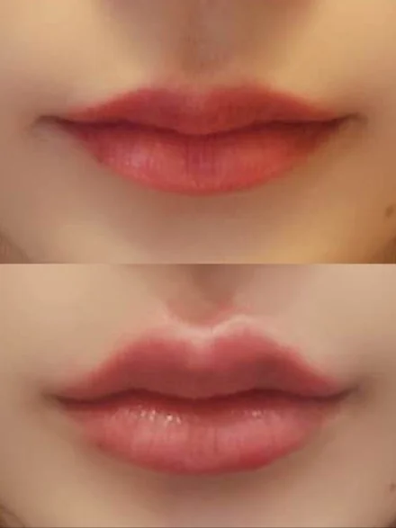 Lip Filler
