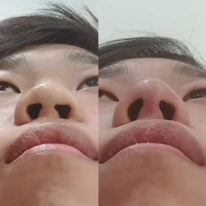Nose Bridge
